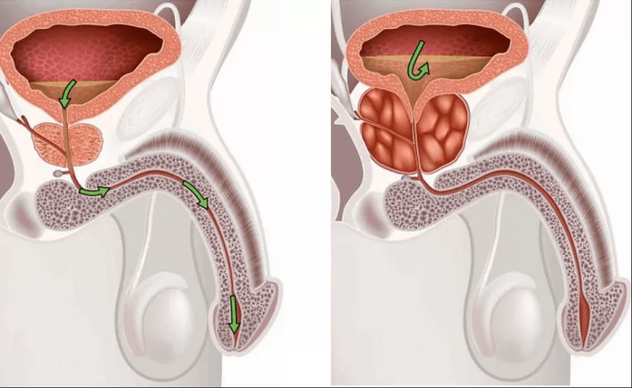 Prostatit belirtileri